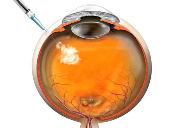 anti-vegf-injection-for-amd