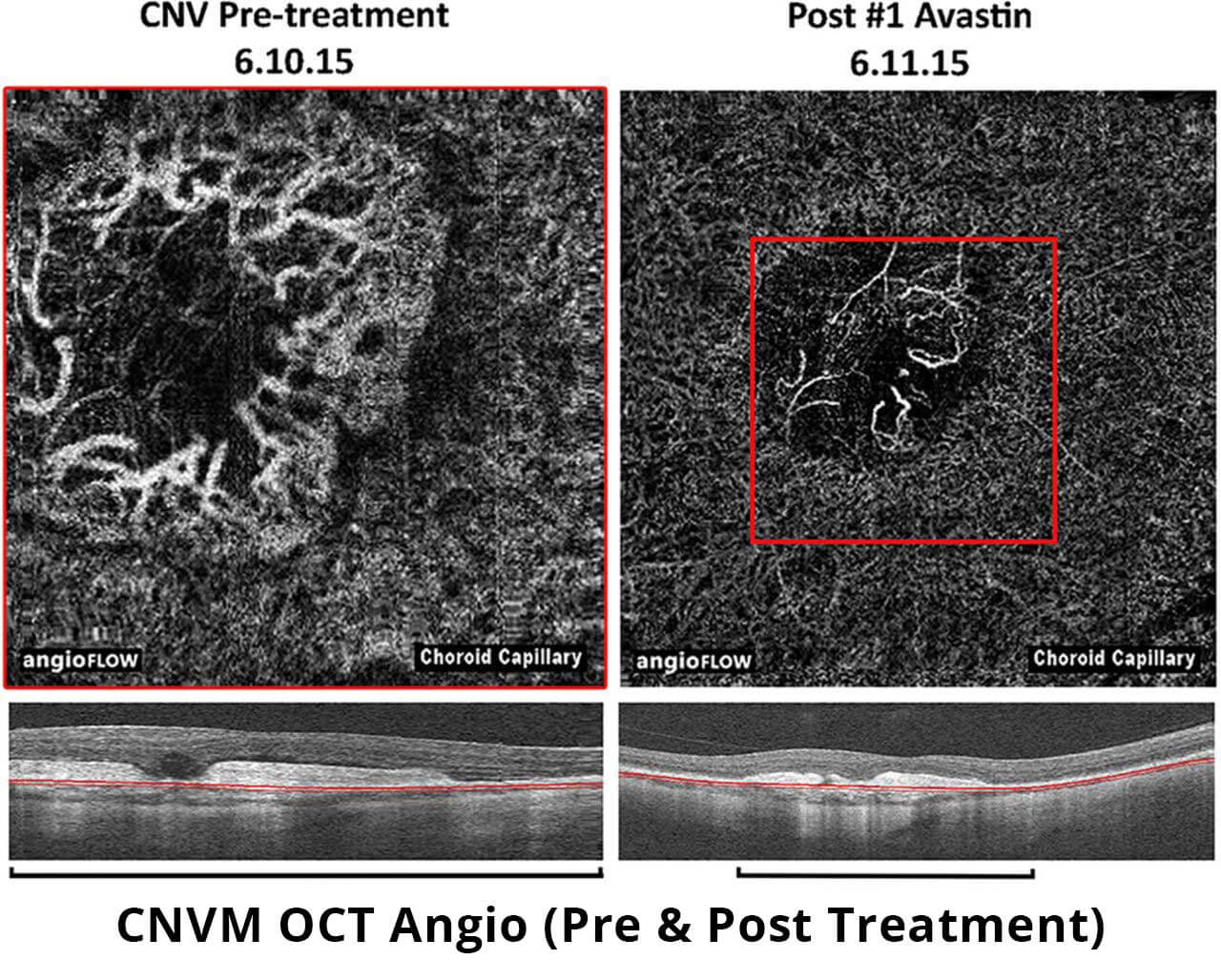 cnvm-pre-and-post-angiography-oct