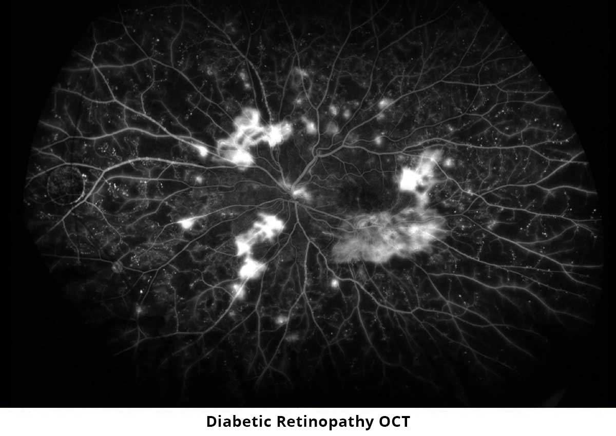 diabetic retinopathy oct