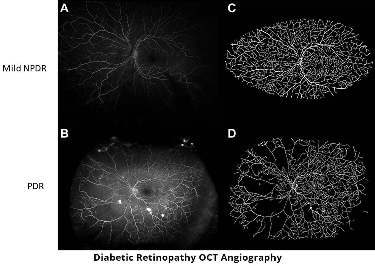 diabetic retinopathy oct angiography
