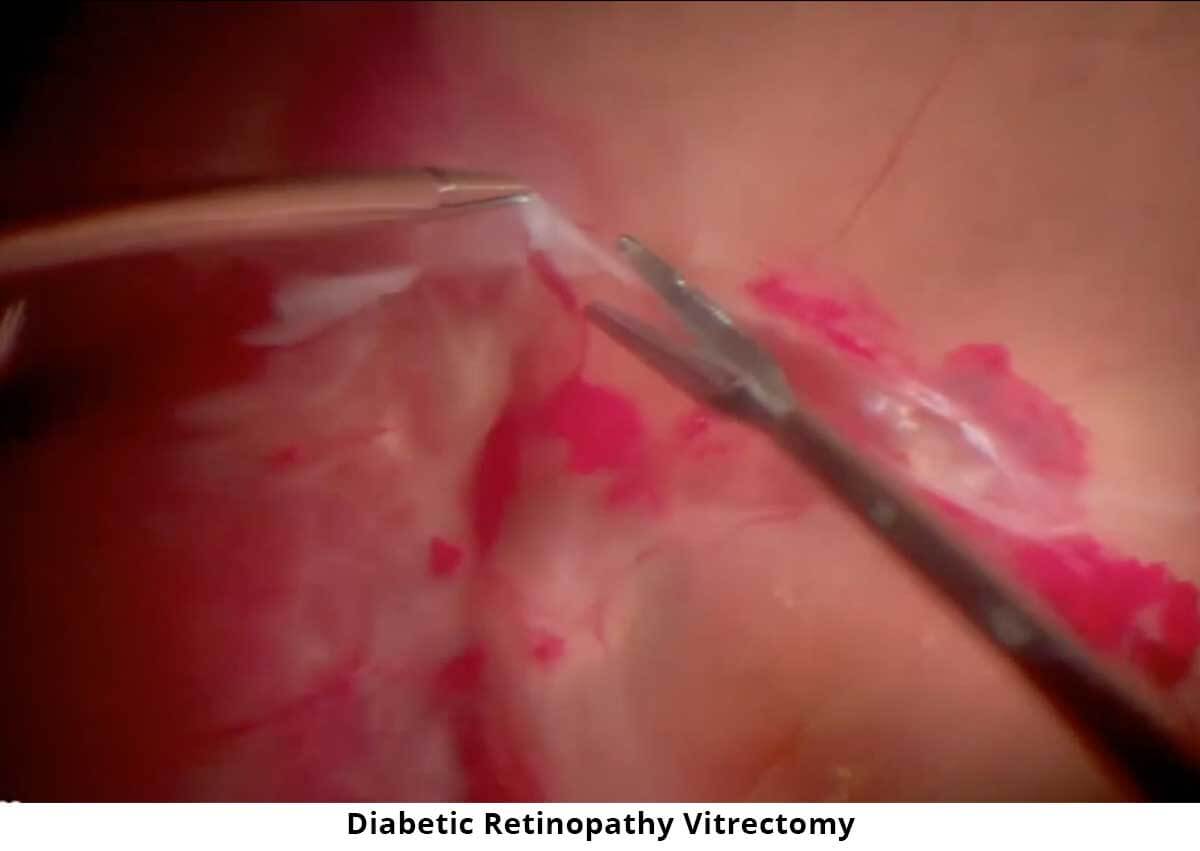 diabetic-retinopathy-vitrectomy