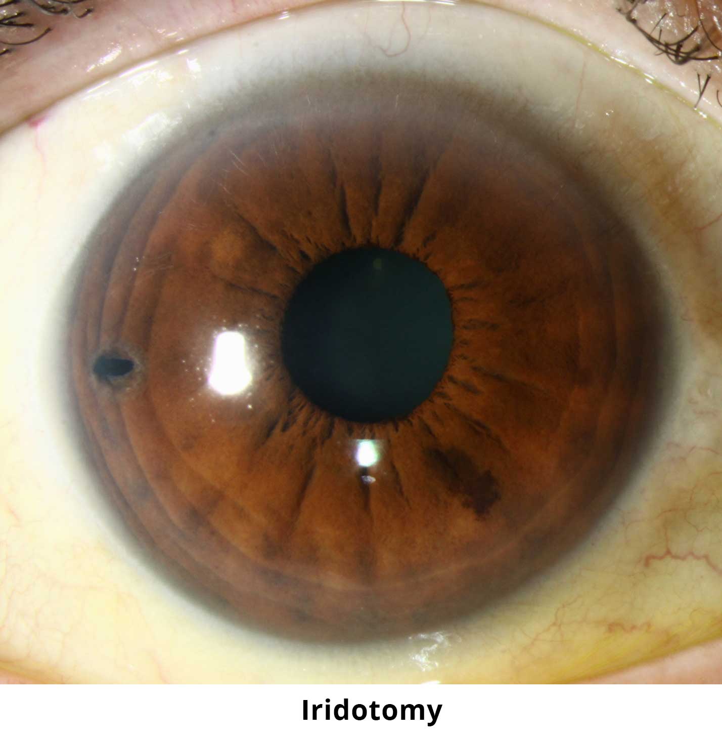 iridotomy2