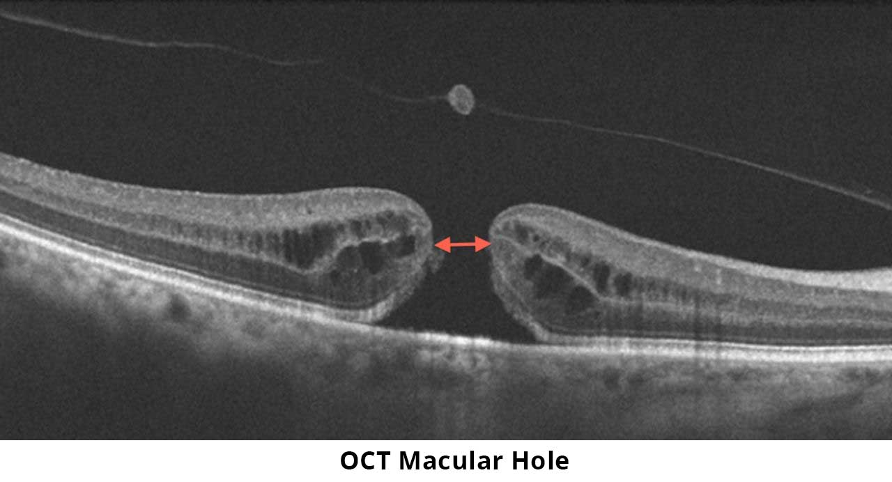 oct macular hole