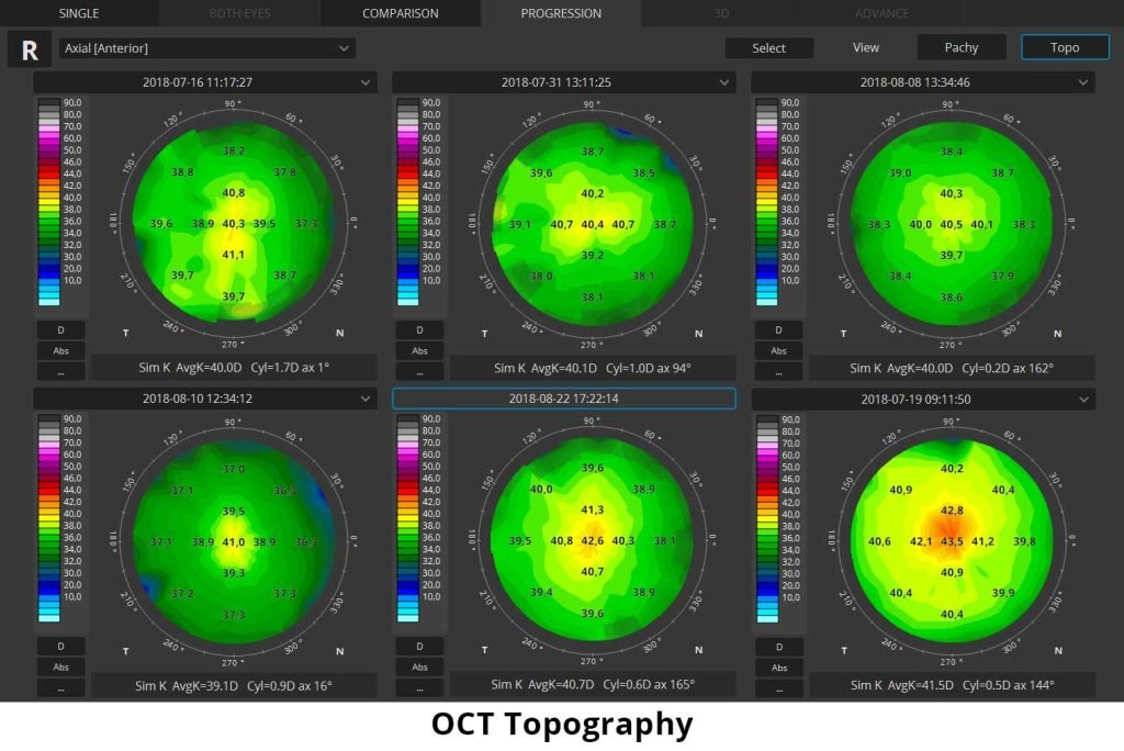 Topography Scan Corneal Topography Mapping the Eye for Accurate Diagnosis & LASIK ...