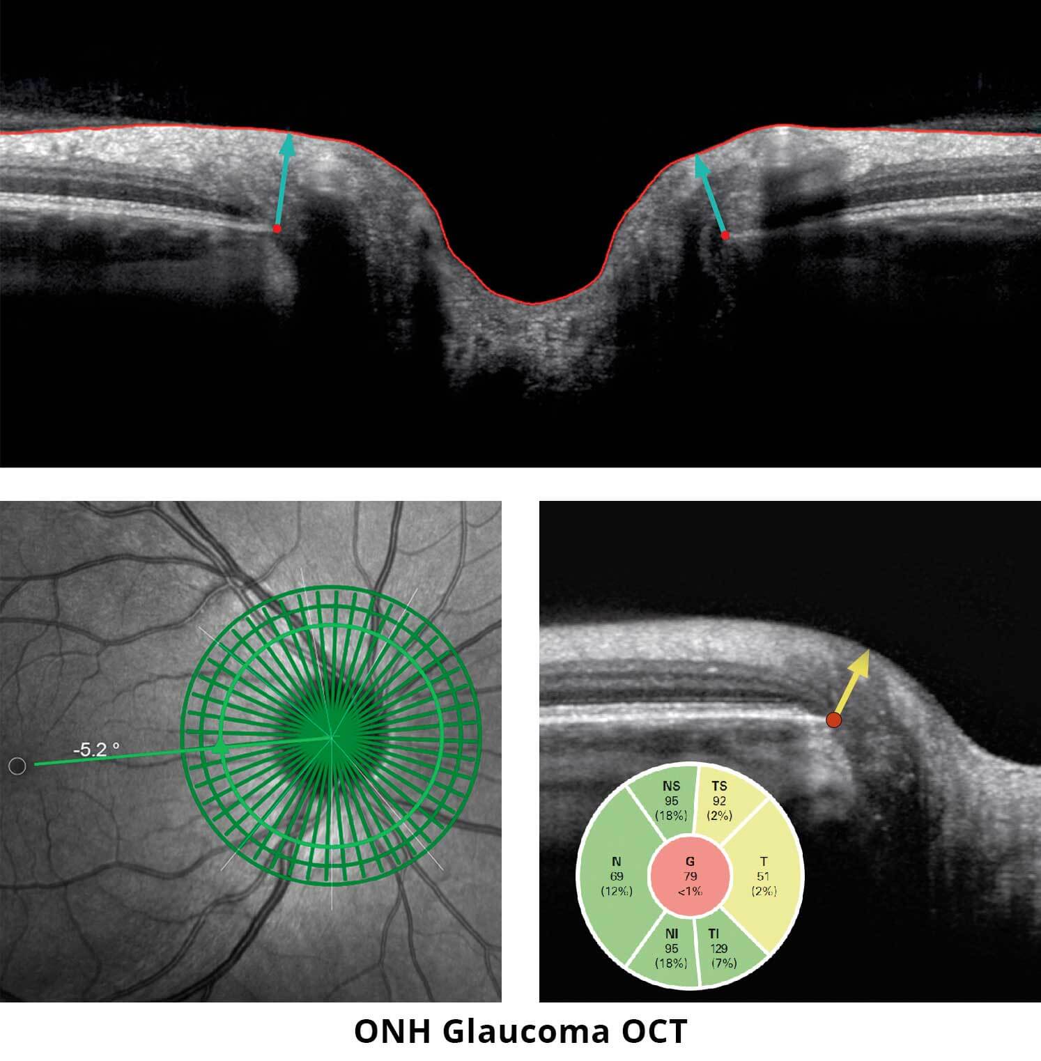 onh-glaucoma-oct