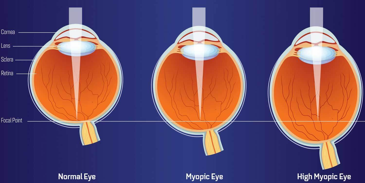 high-myopia