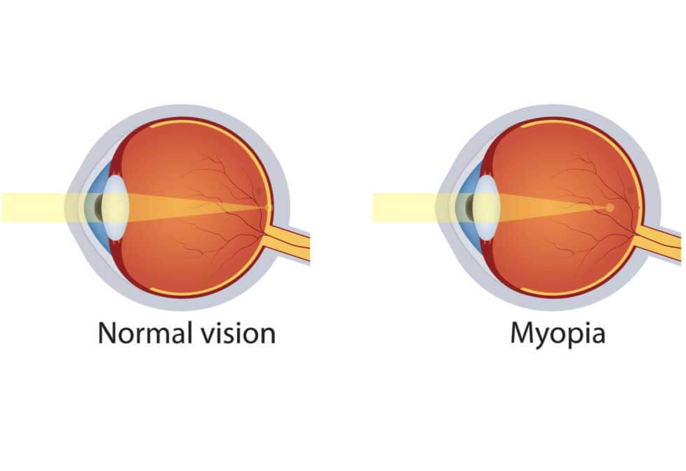 myopia1