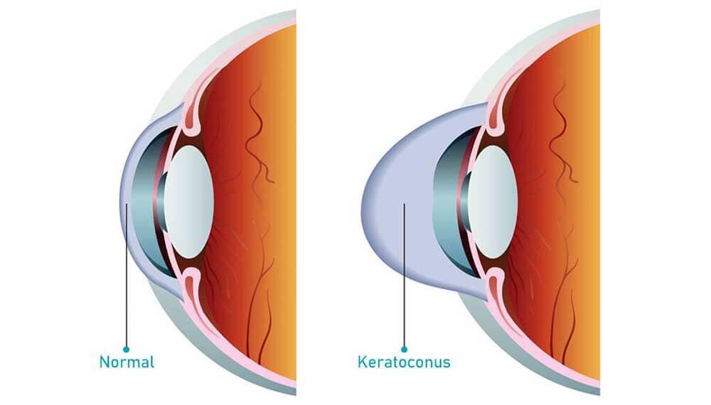 Keratoconus Treatment in Mumbai