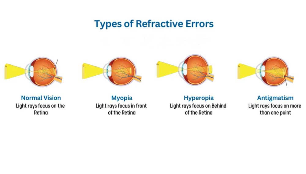 Refractive Errors Types Causes Symptoms and Best Treatment Options