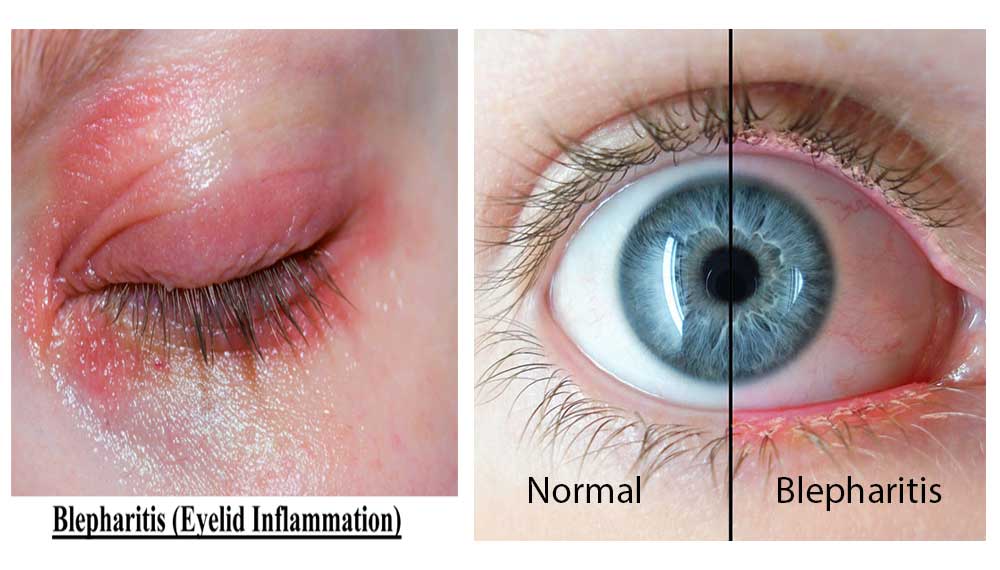 Blepharitis Causes, Symptoms, and Effective Treatment Options
