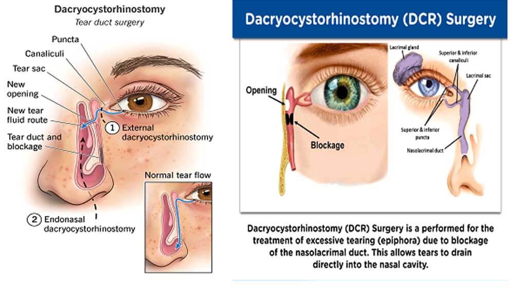 Dacryocystorhinostomy DCRA Procedure to Treat Blocked Tear Ducts