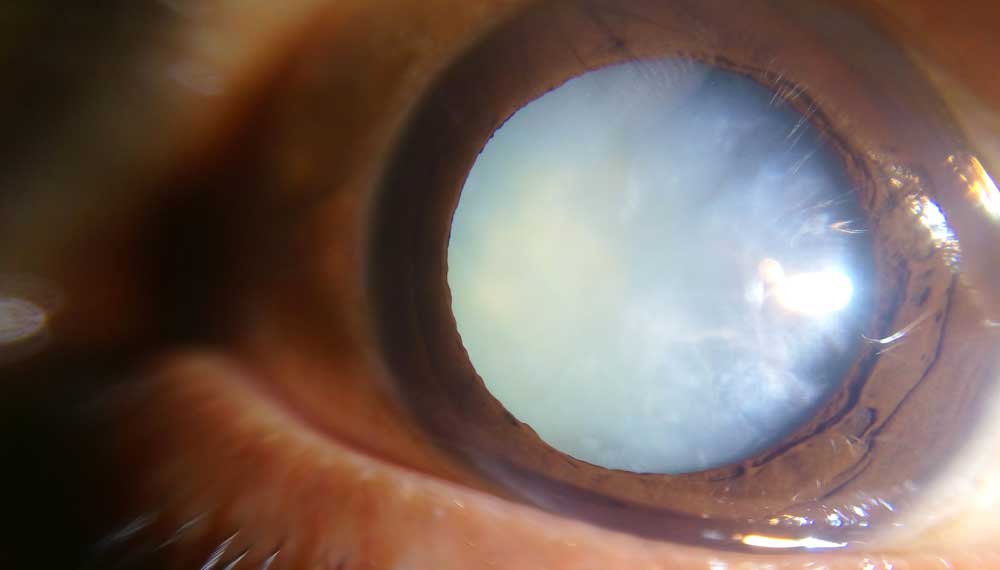 Cataract Causes Treatment Surgery Options and Costs