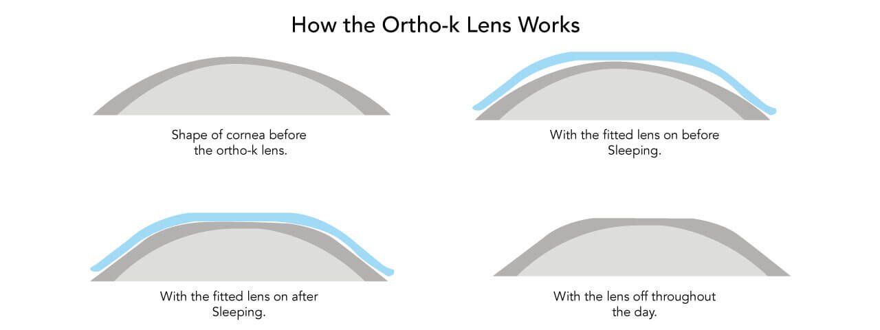 ortho k lens